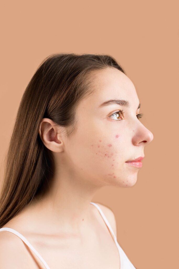 Imagem de uma mulher com espinhas hormonais causadas pela Síndrome do Ovário Policístico (SOP). Explore as manifestações dermatológicas associadas à SOP e descubra dicas eficazes de cuidados com a pele para reduzir a acne hormonal. Aprenda mais sobre os sintomas da SOP e como abordar as questões relacionadas à saúde da pele.